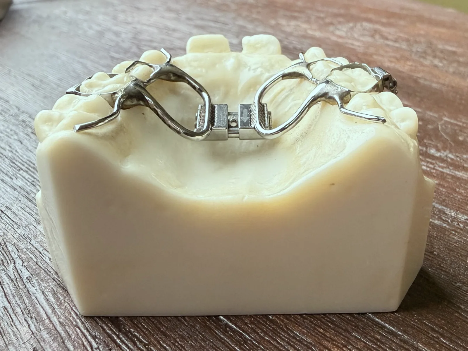Upper orthopedic expander on a study model, viewed from behind across the palate, expansion screw at the midline