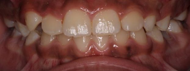 After treatment: crossbite corrected, upper incisors in front of the lowers, frontal intraoral view