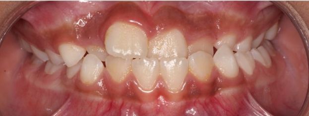 Before treatment: anterior crossbite in the mixed dentition, upper incisors behind the lowers, frontal intraoral view