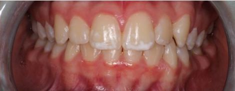 After treatment: upper and lower anterior teeth aligned, frontal intraoral view