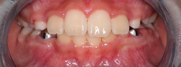 After treatment: upper incisors aligned in the arch, frontal intraoral view