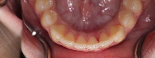 After treatment: lower incisors aligned in a rounded arch, occlusal view of the lower arch