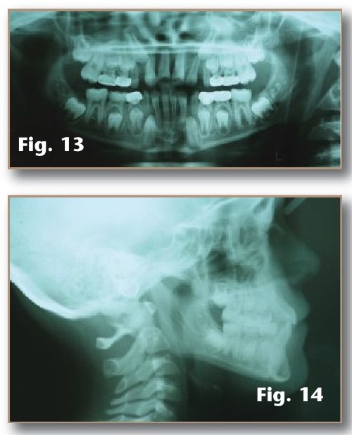 Figures 13–14: post-treatment panoramic and cephalometric radiographs