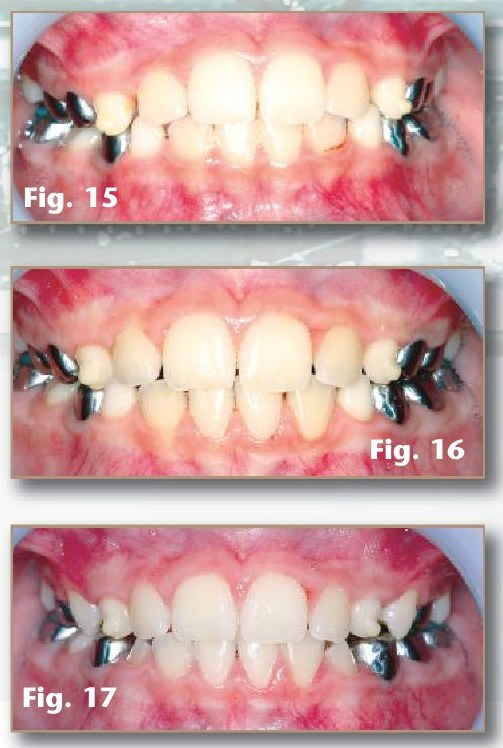 Figures 15–17: frontal views of the occlusion 2, 10 and 22 months post-treatment