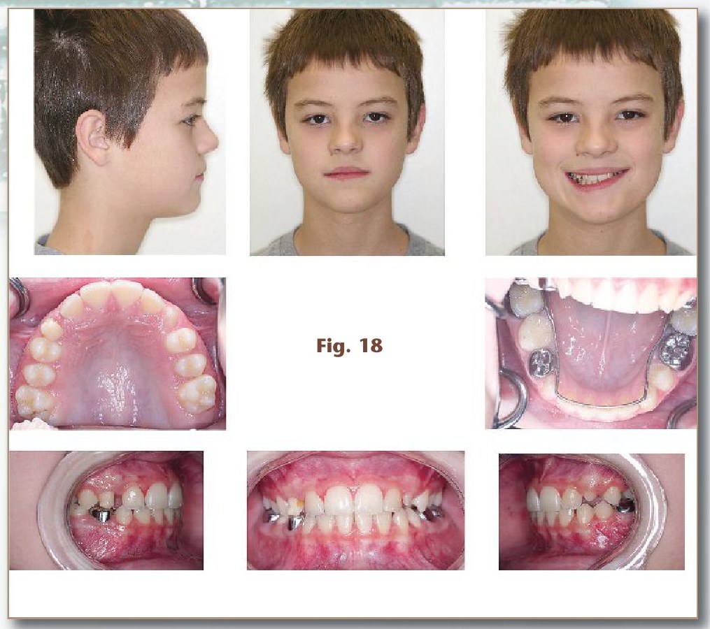 Figure 18: facial photographs, arches and occlusion 28½ months after Phase I