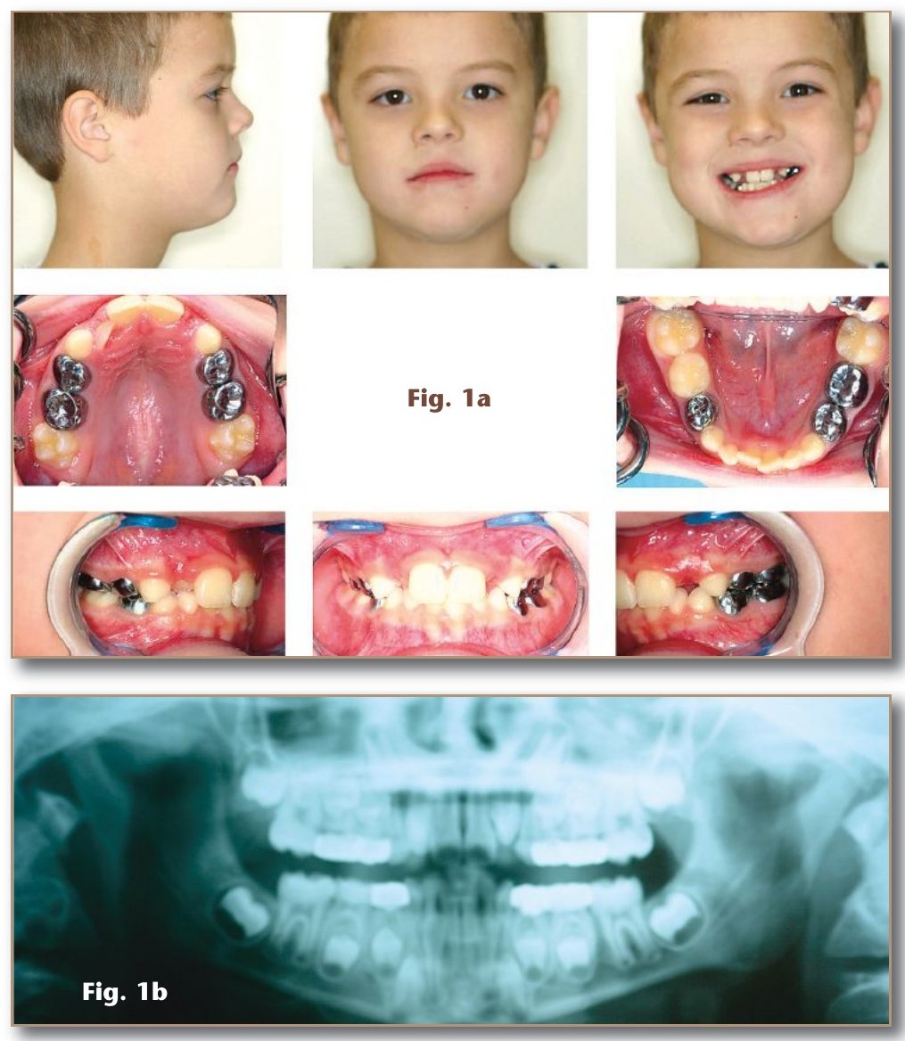 Figures 1a–1b: pre-treatment facial and intraoral photographs and panoramic radiograph
