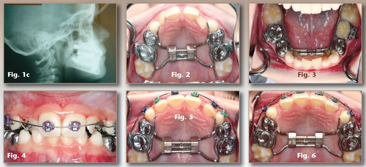 Figures 1c–6: pre-treatment cephalometric radiograph; upper and lower orthopedic expanders banded to the E's; upper anterior brackets and arch form