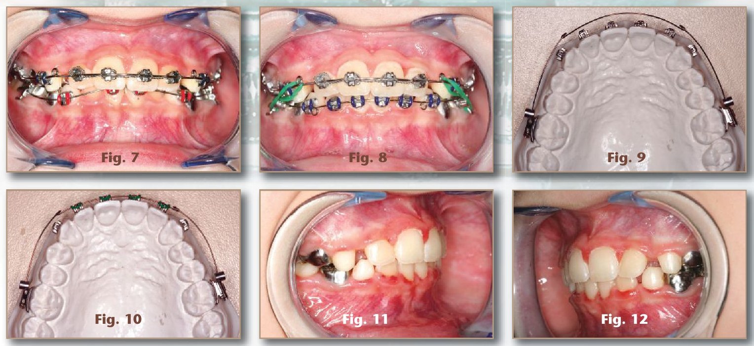 Figures 7–12: lower incisors bracketed; archwire with locks against the molar tubes; right and left buccal views after appliance removal